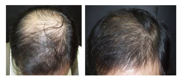 Portfolio usługi Mezoterapia skóry głowy Dr Cyj
