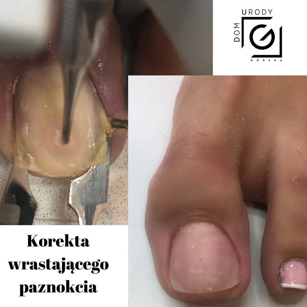 Portfolio usługi Kostka Arkady - korekta wrastających paznokci