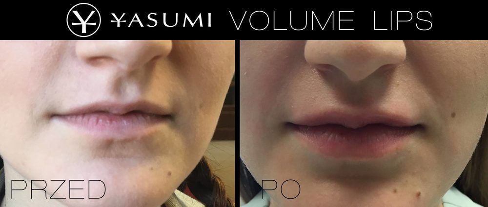 Portfolio usługi Volume Lips - ponętne usta bez igły