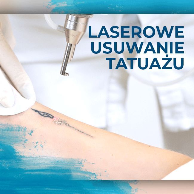 Portfolio usługi Laserowe usuwanie tatuażu