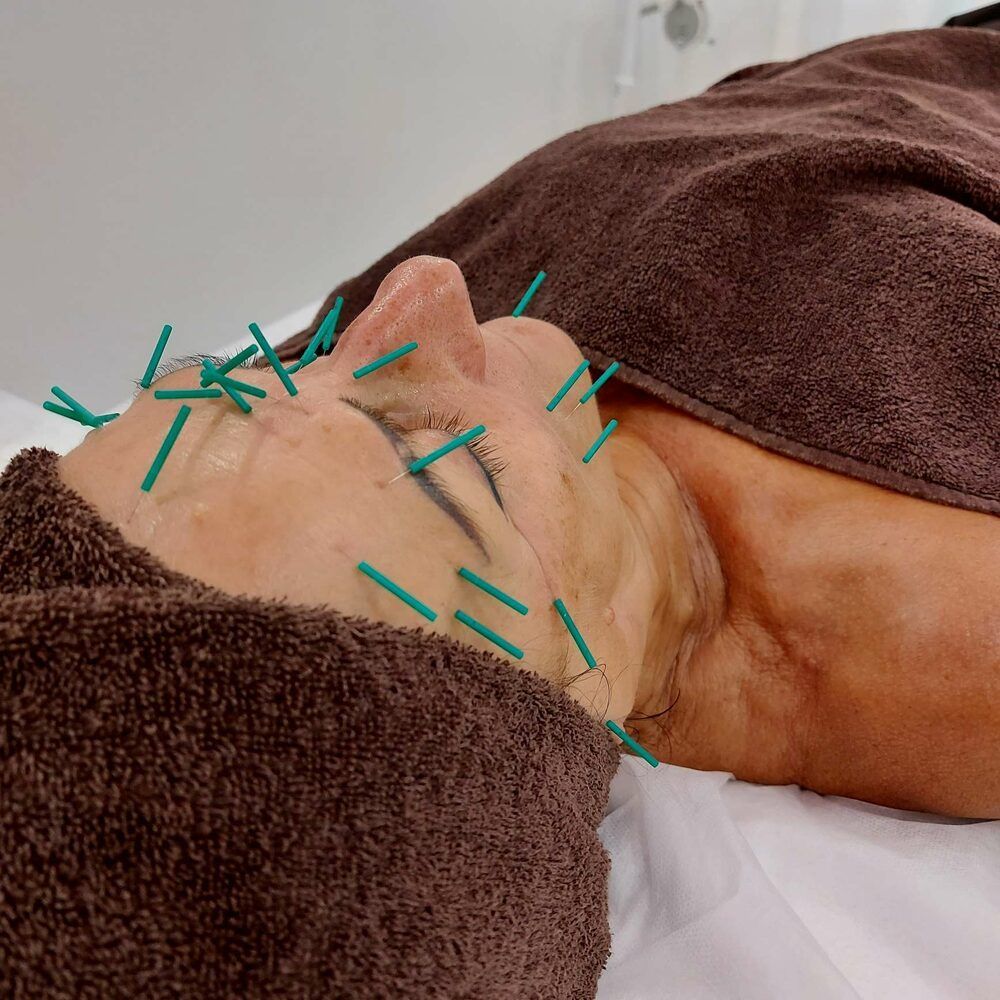 Portfolio usługi Akupunktura kosmetyczna - leczenie skóry i este...