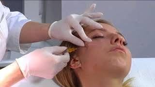 Portfolio usługi Karboksyterapia twarzy