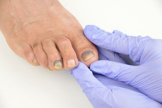 Portfolio usługi Grzybica paznokcia- laserowe leczenie
