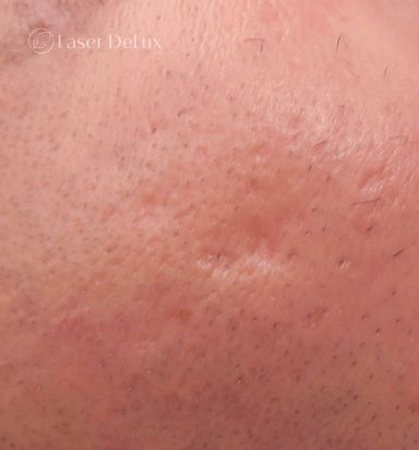 Portfolio usługi Laserowe leczenie trądziku twarz