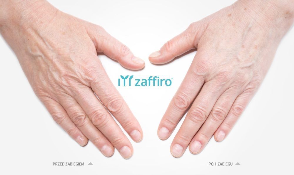 Portfolio usługi Zaffiro LIFTING