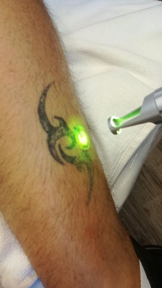 Portfolio usługi Laserowe Usuwanie Tatuażu