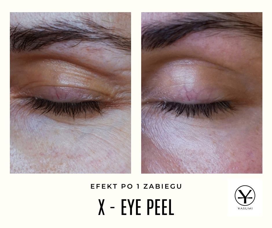 Portfolio usługi X-EYE PEEL - oczy i pielęgnacja twarzy