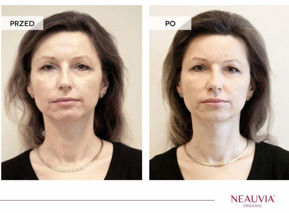 Portfolio usługi Mezoterapia igłowa Neavia Hydro Deluxe  ( twarz...