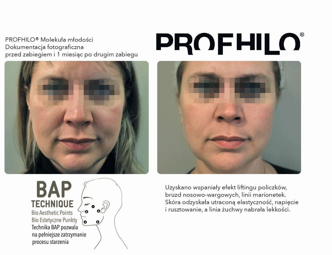 Portfolio usługi PROFHILO biowolumetryczny lifting twarzy 1 zabieg