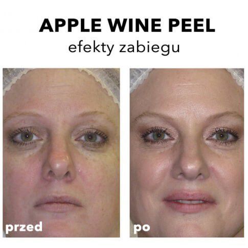 Portfolio usługi Peeling medyczny Apple wine peel Rhonda Allison