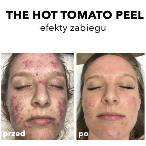 Portfolio usługi The Hot Tomato Peel - Zabieg do cery trądzikowych