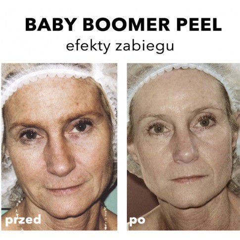 Portfolio usługi Baby Boomer Peel - Peeling średnio głęboki