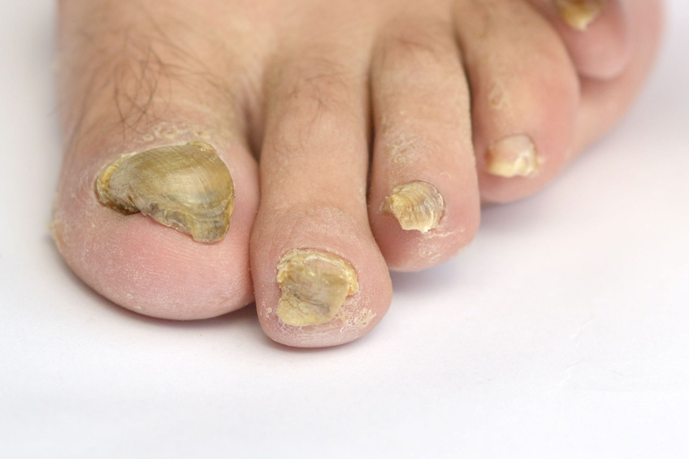 Portfolio usługi Diagnostyka i oczyszczenie paznokci zmienionych