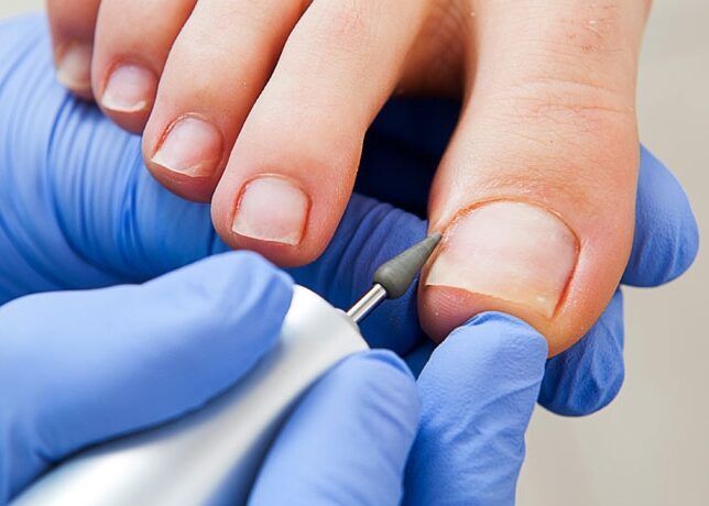 Portfolio usługi Oczyszczenie paznokcia zmienionego / uszkodzonego