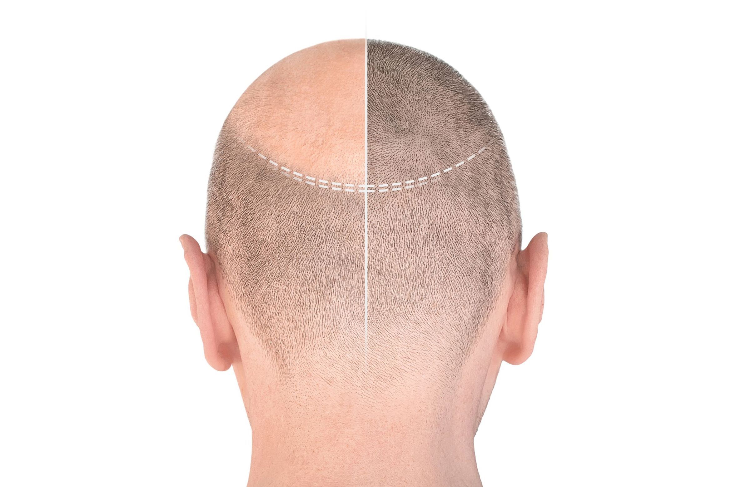 PRP - Hair Growth Restoration ( Half Head ) portfolio