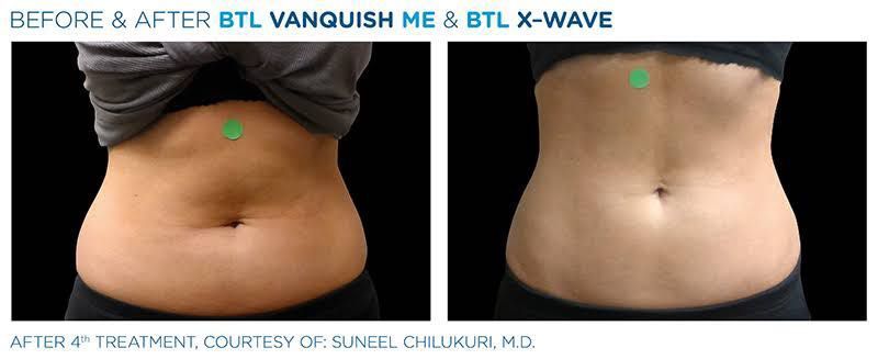 XWAVE cellulite and skin tightening (abdomen) portfolio