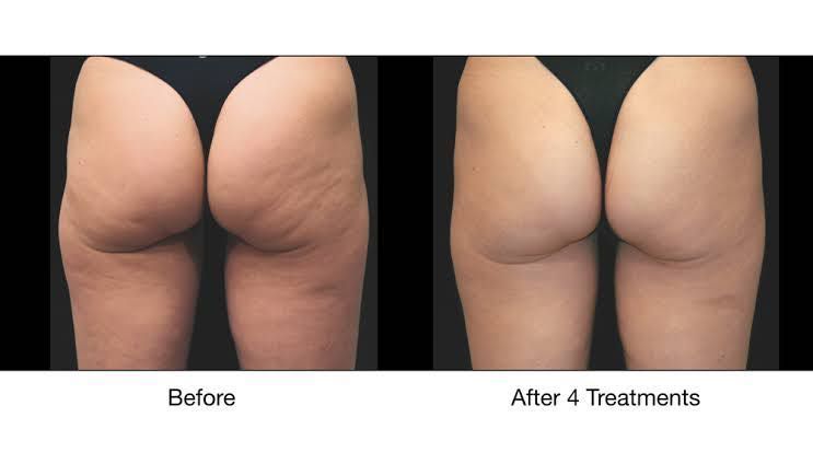 XWAVE skin tightening and cellulite (thighs) portfolio