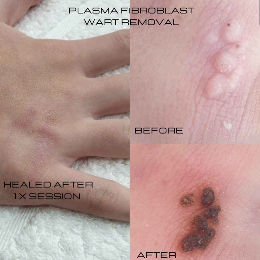 Skin tags, warts, lesion, sunspot, scar portfolio