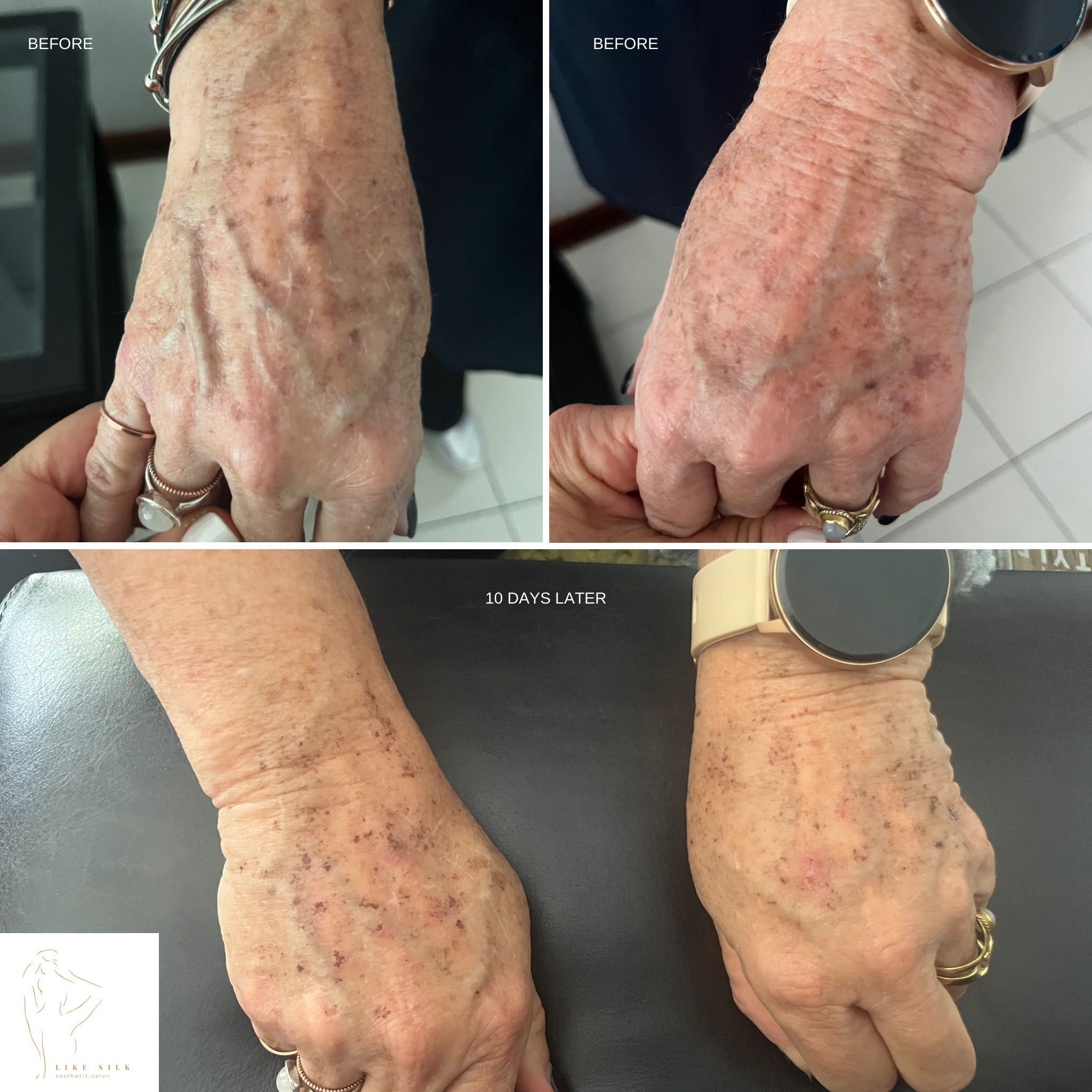 Hand Skin Rejuvenation portfolio