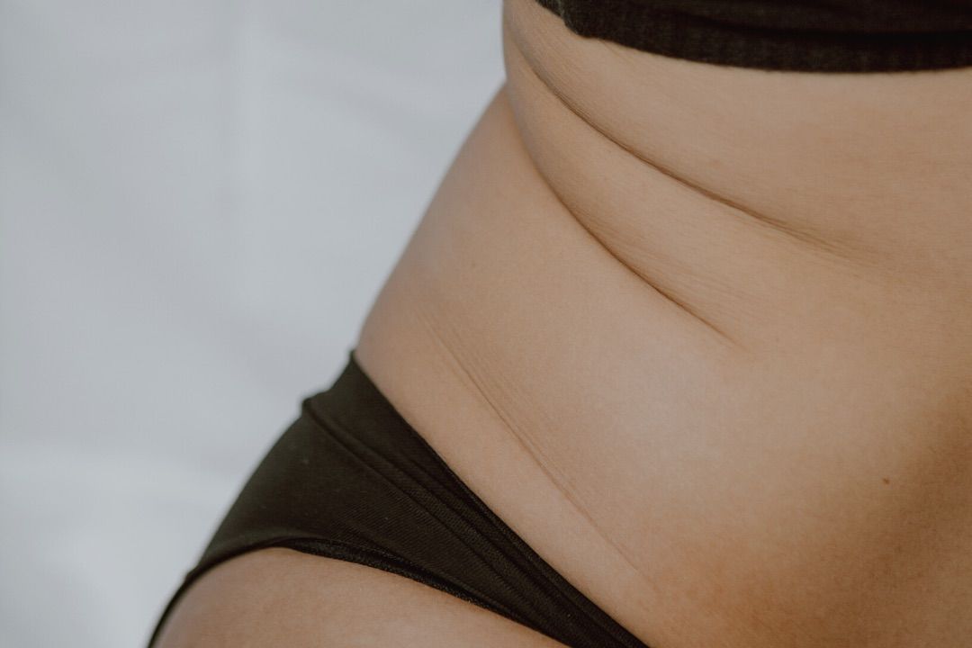 Tummy, Back & Love Handles - Fat Reduction portfolio