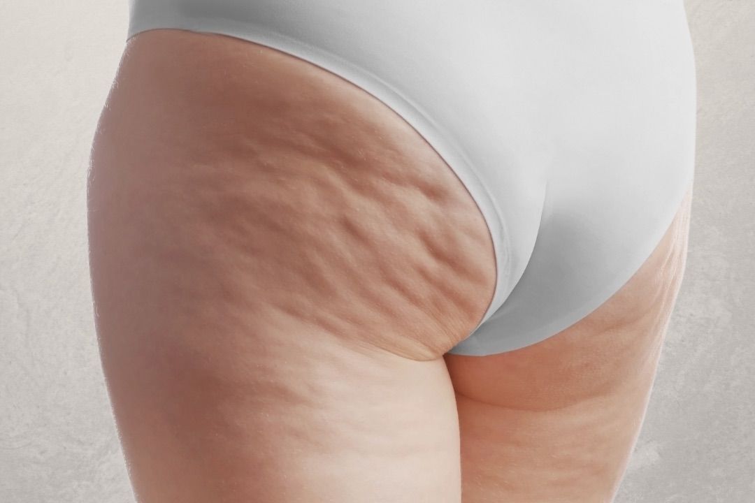 Cellulite Reduction On Bum portfolio