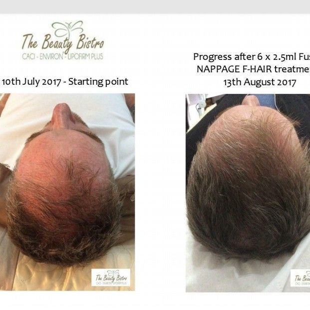 Scalp Hair restoration portfolio