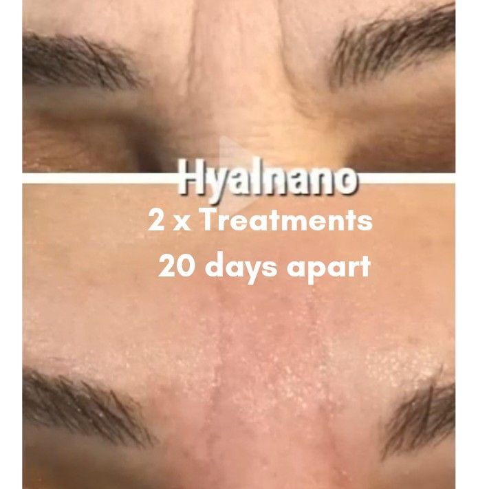 Hyal Nano Filler Forehead portfolio